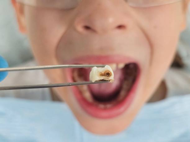 Best Broken or Cracked Tooth Emergency Dentist in Higganum, CT
